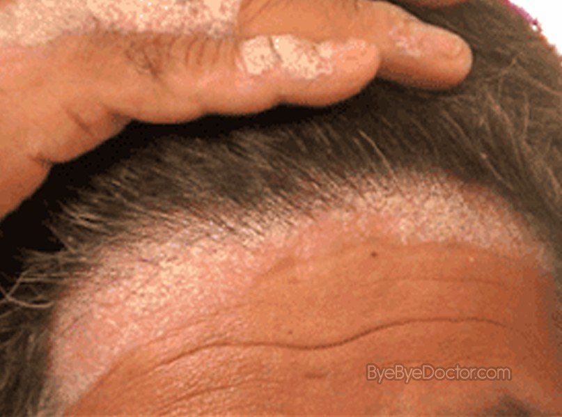 Scalp Psoriasis