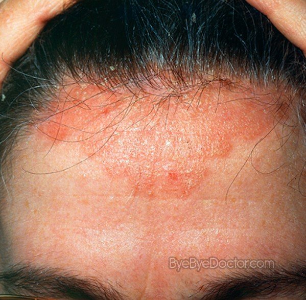 Scalp Psoriasis