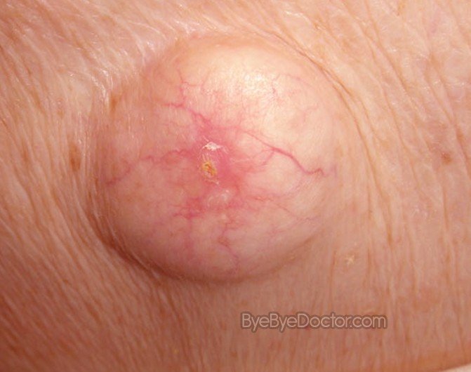 Sebaceous Cyst On Scalp