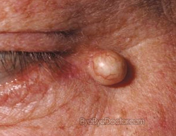 Epidermoid Cyst