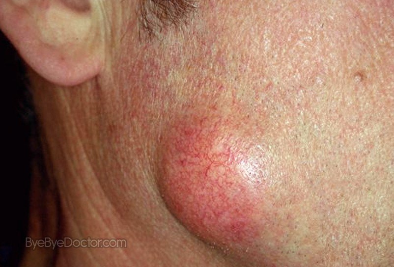 Epidermoid Cyst in Adults: Condition, Treatments, and ...