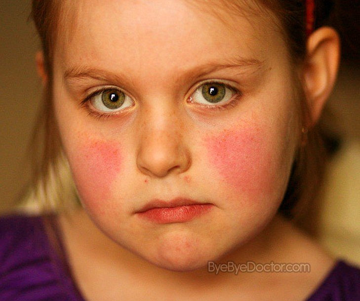 Fifth Disease