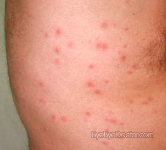 hot tub rash - Centers for Disease Control and Prevention