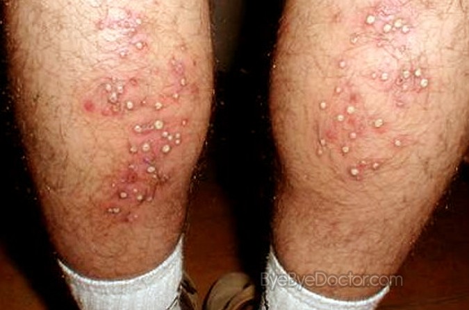 rash from hot tubs #10