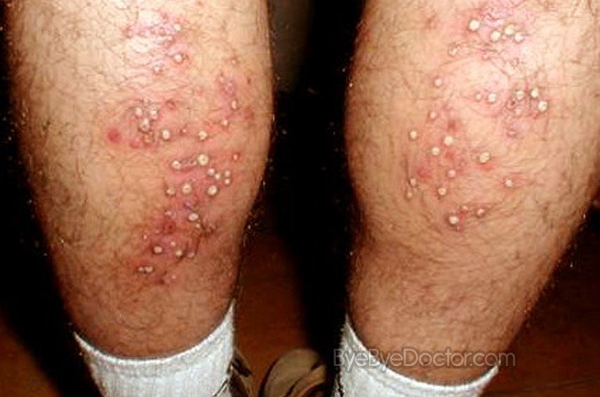 Hot Tub Rash (Pseudomonas Folliculitis) in Adults ...