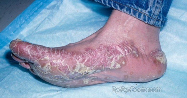 Hyperkeratosis