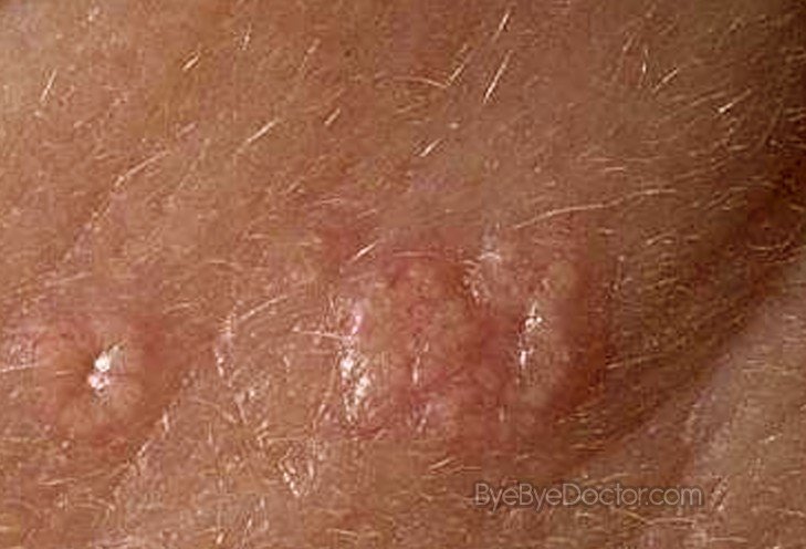 Sebaceous Hyperplasia