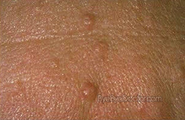 Sebaceous Hyperplasia