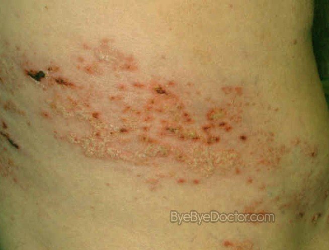 Shingles - Pictures, Symptoms, Causes, Treatment, Contagious