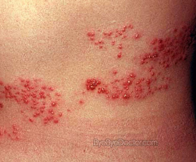 shingles pictures