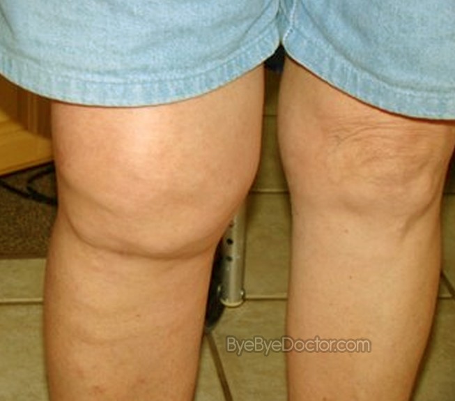 Swollen Knee – Causes, Treatment, Pain relief, Pictures
