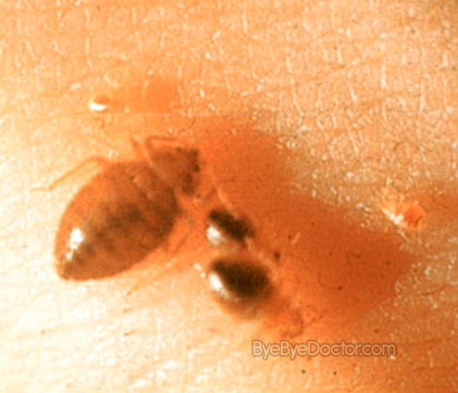 Bed Bug Infestation â€“ Signs, Prevention, Treatment, Pictures