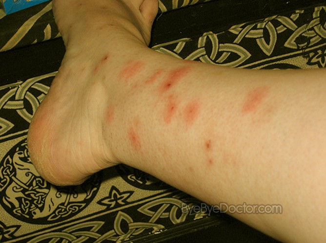 bed bugs signs. Bed Bug Infestation Pictures