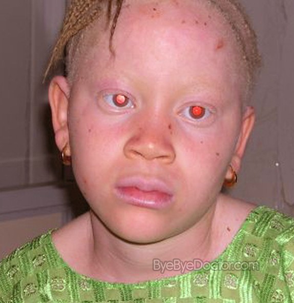 albinism pictures