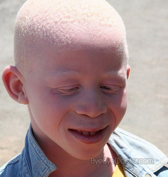 albinism pictures