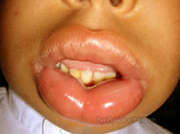 Hives and angioedema Symptoms and causes - Mayo Clinic