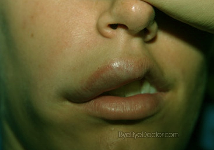 What are some symptoms of angioedema?