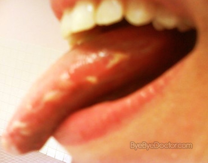 Bumps On Tongue