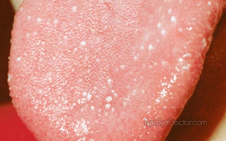 white-spots-on-tongue-tip-side-under-back-dots-patches-single