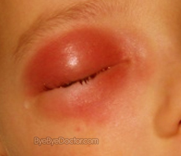 cellulitis pictures