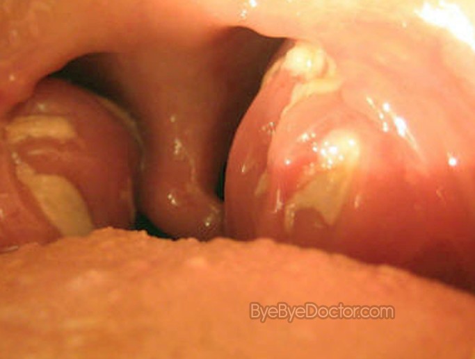 swollen tonsils pictures