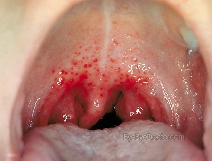 Red Swollen Throat 54