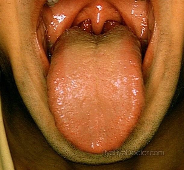 swollen tonsils pictures