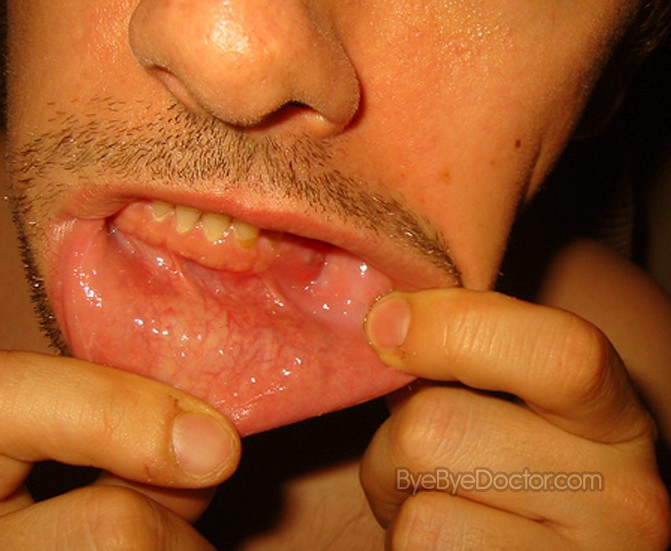 tooth abscess pictures