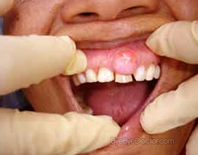 tooth abscess pictures