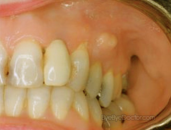 tooth abscess pictures