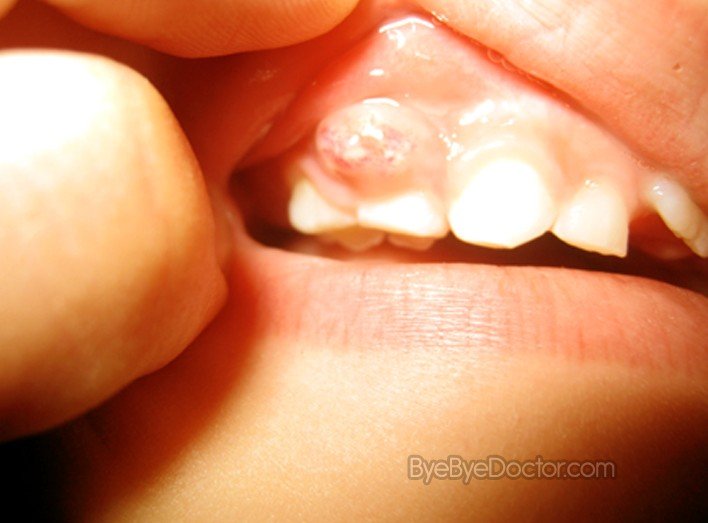 How is an abscessed tooth treated?