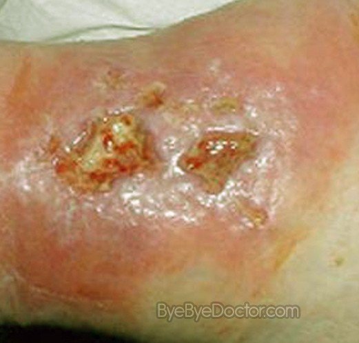 Wound Infection Pictures