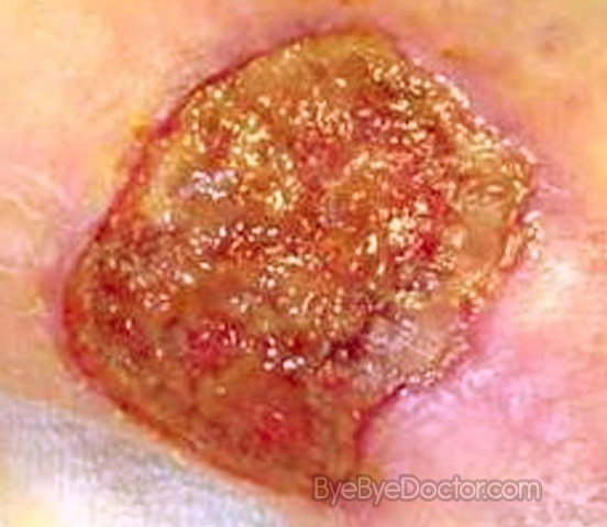 Wound Infection Pictures