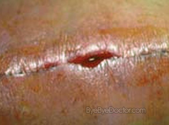 Wound Infection Pictures