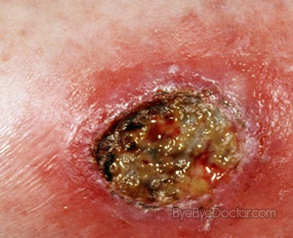 Wound Infection Pictures
