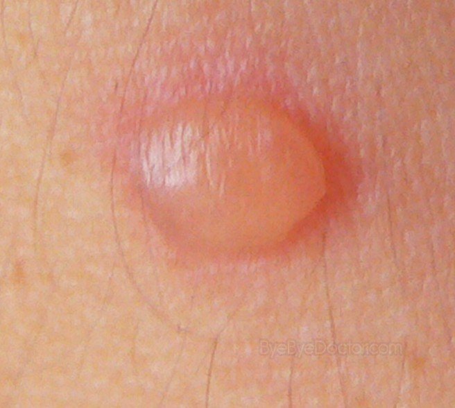 blood-blisters-causes-treatment-pictures