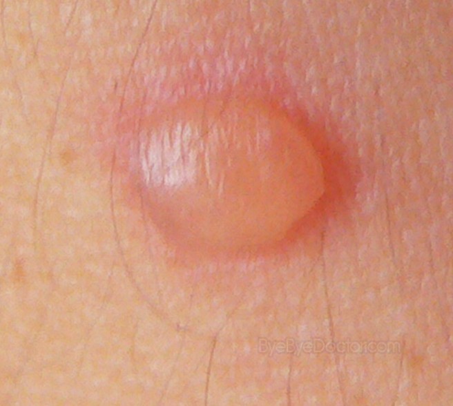 Blood Blisters Causes Treatment Pictures