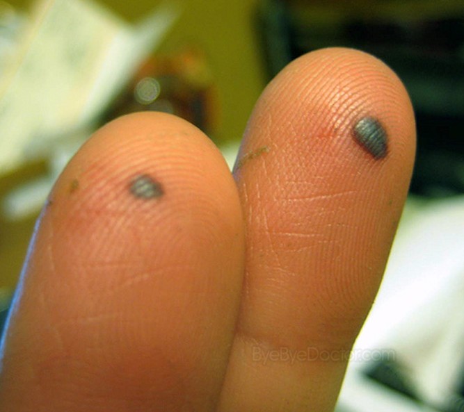 Infected Blood Blister On Finger