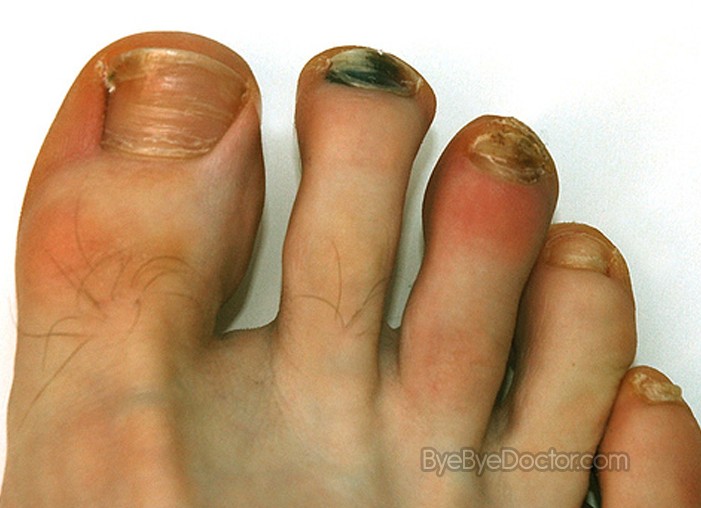 blood blisters pictures