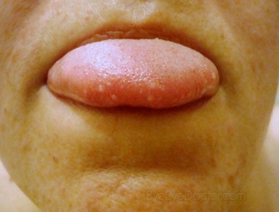 canker sore on tongue pictures