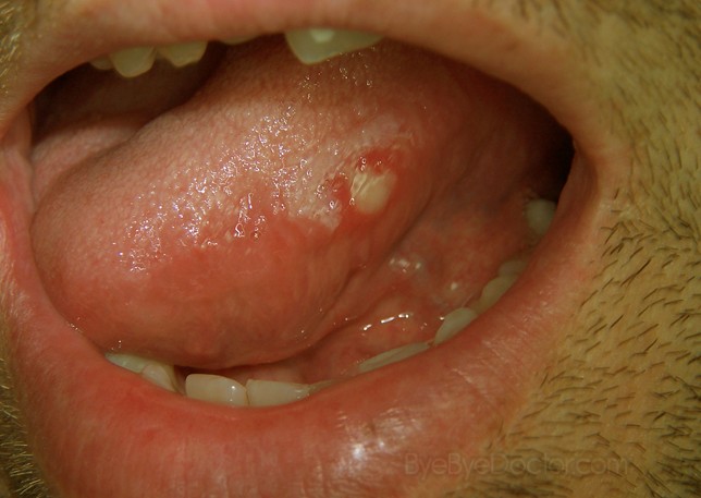 canker sore on tongue pictures