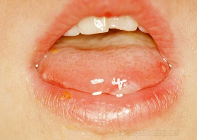 hand foot and mouth disease pictures