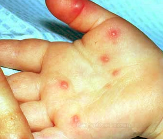 hand foot and mouth disease pictures
