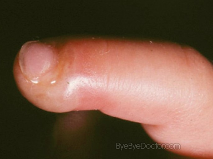 Herpetic whitlow (whitlow finger) - NHS Choices
