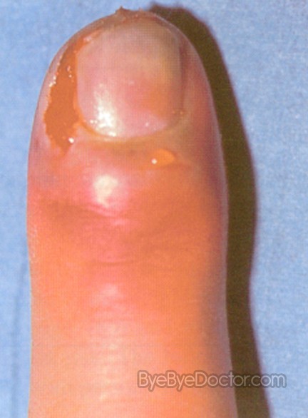 Herpetic Whitlow - Causes, Pictures, Symptoms, Treatment ...