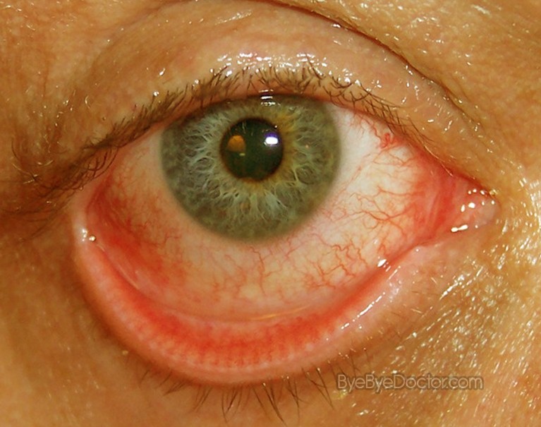 Pink Eye - Pictures, Symptoms, Treatment, Contagious, Remedies, Causes