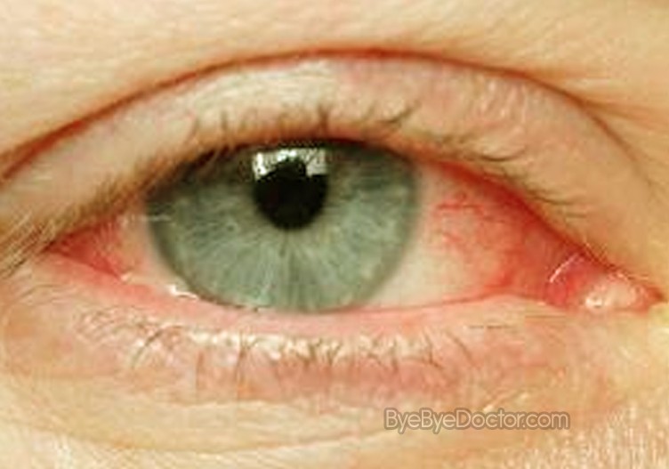 pink eye pictures