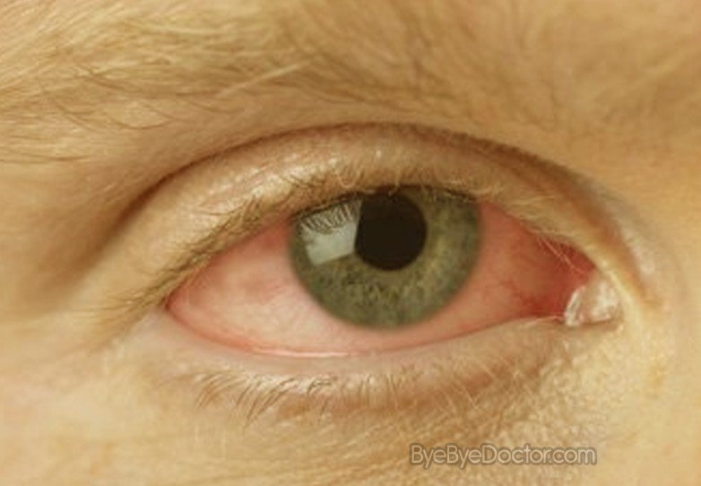 Conjunctivitis (Pinkeye) - WebMD