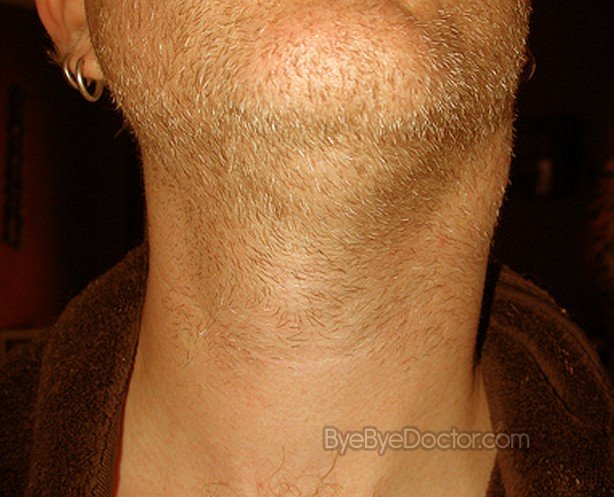 Swollen Glands In Neck Swollen Glands In Neck