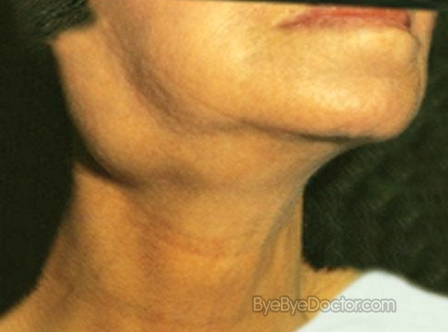 Swollen Glands In Neck Causes Treatment Pictures